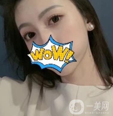 武漢艾萊美醫(yī)療整形醫(yī)院價(jià)格表項(xiàng)目收費(fèi)明細(xì)，附雙眼皮案例