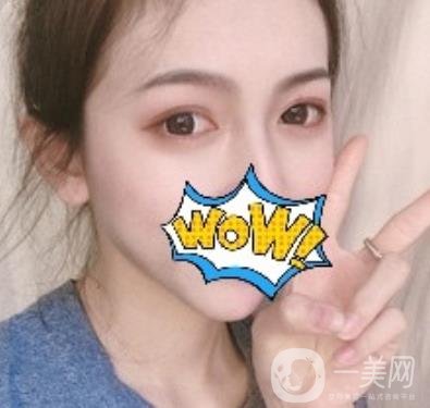 武漢艾萊美醫(yī)療整形醫(yī)院價(jià)格表項(xiàng)目收費(fèi)明細(xì)，附雙眼皮案例