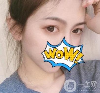 武漢艾萊美醫(yī)療整形醫(yī)院價(jià)格表項(xiàng)目收費(fèi)明細(xì)，附雙眼皮案例