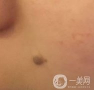 重醫(yī)附一院祛痣怎么樣？多少錢一顆？附整形價格表及案例果