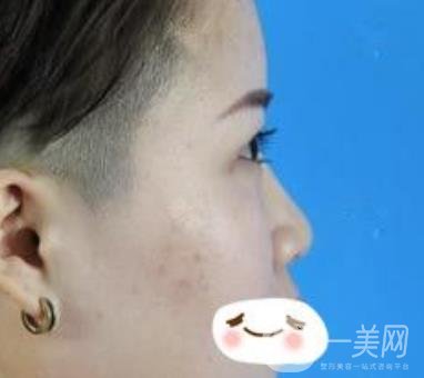四川省人民醫(yī)院整形科駝峰鼻矯正多少錢(qián)？?jī)r(jià)格表2020更新
