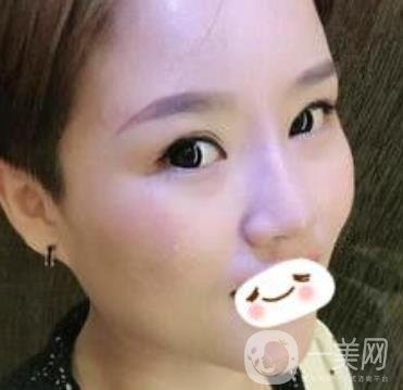 四川省人民醫(yī)院整形科駝峰鼻矯正多少錢(qián)？?jī)r(jià)格表2020更新