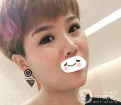 四川省人民醫(yī)院整形科駝峰鼻矯正多少錢(qián)？?jī)r(jià)格表2020更新