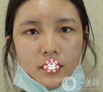 襄陽中心醫(yī)院整形美容科價格表2020版出爐，附雙眼皮日記