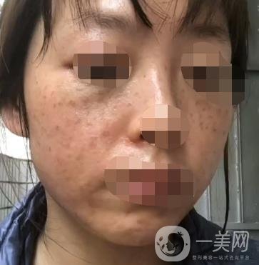 岳陽(yáng)市一人民醫(yī)院整形美容科價(jià)格表及祛斑案例發(fā)布