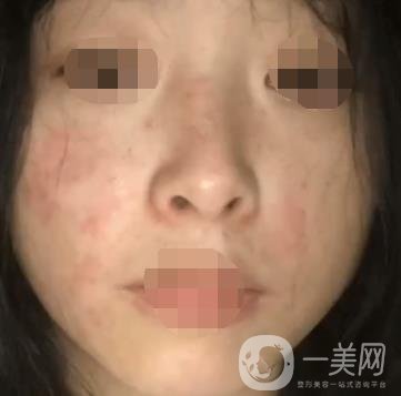 岳陽(yáng)市一人民醫(yī)院整形美容科價(jià)格表及祛斑案例發(fā)布