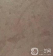 廣州名韓整形醫(yī)院價格表費(fèi)用詳情+激光祛斑案例分享