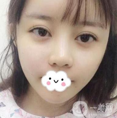 合肥中山醫(yī)院整形科價格表2020，附雙眼皮恢復(fù)*果