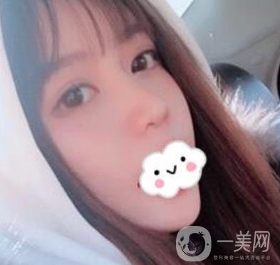 合肥中山醫(yī)院整形科價格表2020，附雙眼皮恢復(fù)*果