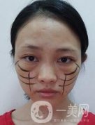 徐州亞韓整形醫(yī)院價格表費用明細，附面部除皺日記展示