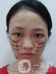 徐州亞韓整形醫(yī)院價(jià)格表費(fèi)用明細(xì)，附面部除皺日記展示