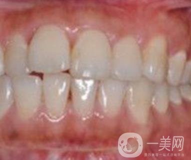 武漢大學(xué)口腔醫(yī)院牙齒矯正多少錢(qián)?*果好嗎?價(jià)格費(fèi)用明細(xì)一覽