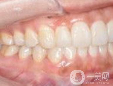 武漢大學(xué)口腔醫(yī)院牙齒矯正多少錢(qián)?*果好嗎?價(jià)格費(fèi)用明細(xì)一覽