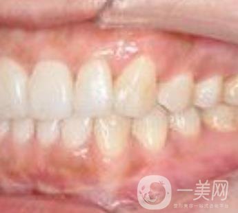 武漢大學(xué)口腔醫(yī)院牙齒矯正多少錢(qián)?*果好嗎?價(jià)格費(fèi)用明細(xì)一覽