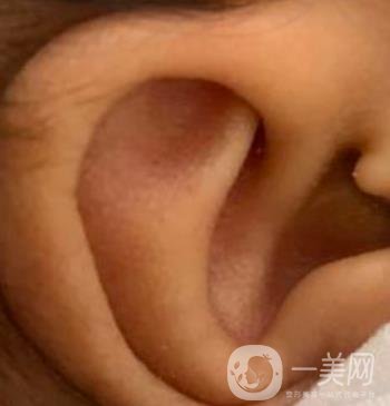 中國醫(yī)學(xué)科學(xué)院整形外科醫(yī)院外耳再造技術(shù)如何?*果好嗎?價(jià)格表收費(fèi)標(biāo)準(zhǔn)一覽