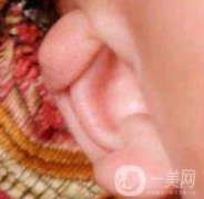 中國醫(yī)學(xué)科學(xué)院整形外科醫(yī)院外耳再造技術(shù)如何?果好嗎?價格表收費標(biāo)準(zhǔn)一覽