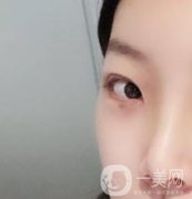 無錫二院雙眼皮做得好的醫(yī)生？附2020整形價格表及案例