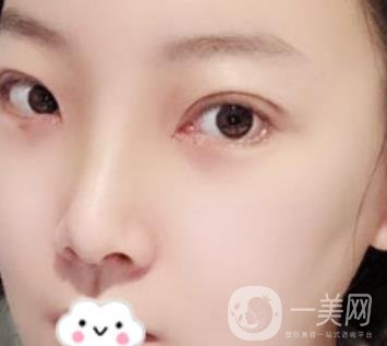 無錫二院雙眼皮做得好的醫(yī)生?附2020整形價(jià)格表及案例