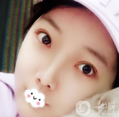 無錫二院雙眼皮做得好的醫(yī)生?附2020整形價(jià)格表及案例