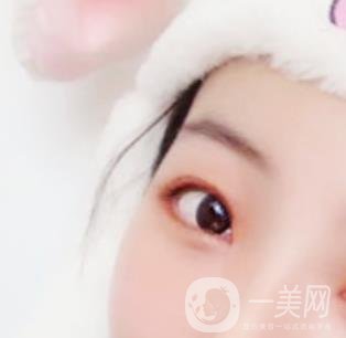 無錫二院雙眼皮做得好的醫(yī)生?附2020整形價(jià)格表及案例