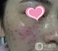 徐州二院激光祛斑怎么樣？案例及2020整形價格表一覽