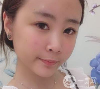 重醫(yī)附一院祛痣多少錢一顆?2020整形價(jià)格表及案例*果圖分享