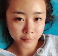 重醫(yī)附一院祛痣多少錢一顆？2020整形價格表及案例果圖分享