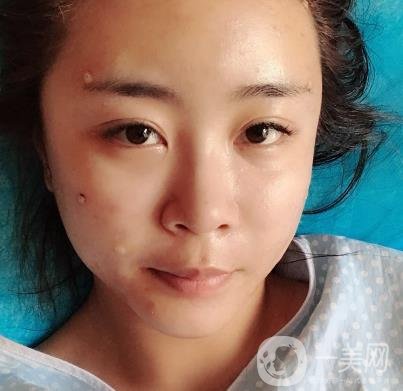 重醫(yī)附一院祛痣多少錢一顆?2020整形價(jià)格表及案例*果圖分享