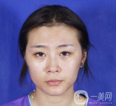 重醫(yī)附一院祛痣多少錢一顆?2020整形價(jià)格表及案例*果圖分享