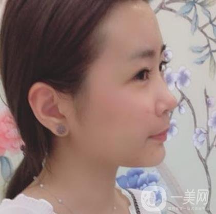 重醫(yī)附一院祛痣多少錢一顆?2020整形價(jià)格表及案例*果圖分享