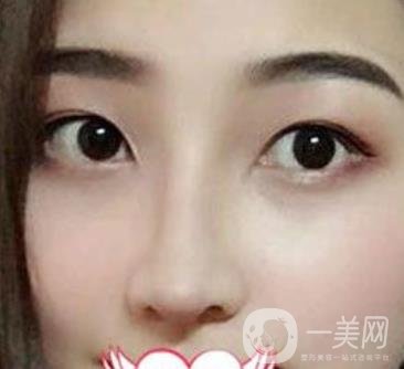 交大一附院王瑞做鼻子怎么樣？價格表及術后*果分享