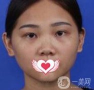 交大一附院王瑞做鼻子怎么樣？?jī)r(jià)格表及術(shù)后果分享