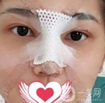 交大一附院王瑞做鼻子怎么樣？價格表及術后*果分享