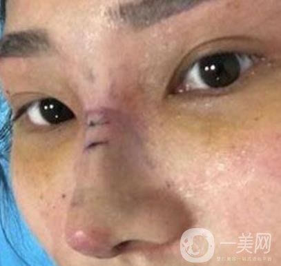 交大一附院王瑞做鼻子怎么樣？價格表及術后*果分享