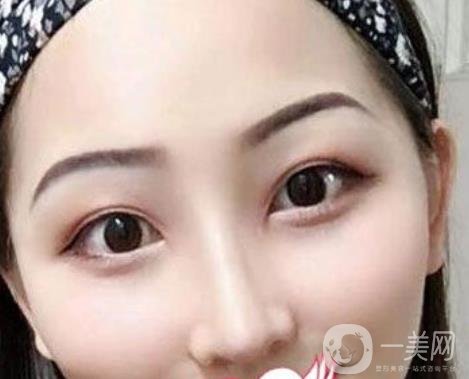 交大一附院王瑞做鼻子怎么樣？價格表及術后*果分享