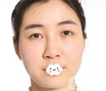 南昌二附院整形科新版價(jià)格表發(fā)布,附隆鼻案例前后
