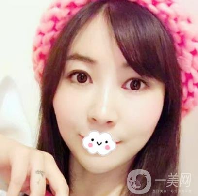 南昌二附院整形科新版價(jià)格表發(fā)布,附隆鼻案例前后