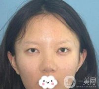 贛南醫(yī)學(xué)院第一附屬醫(yī)院整形美容科價(jià)格表2020+雙眼皮案例一覽