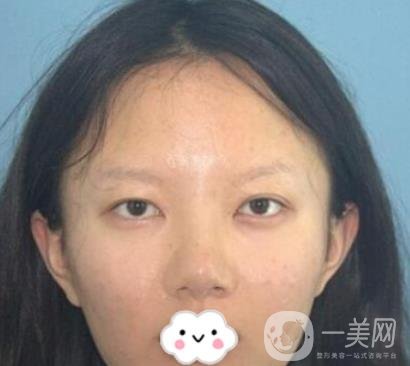 贛南醫(yī)學(xué)院第一附屬醫(yī)院整形美容科價格表2020+雙眼皮案例一覽
