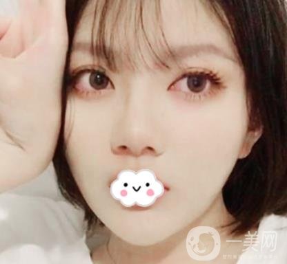贛南醫(yī)學(xué)院第一附屬醫(yī)院整形美容科價格表2020+雙眼皮案例一覽