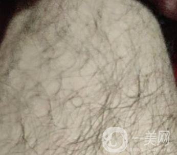 合肥華美整形醫(yī)院價(jià)格表，附脫毛案例