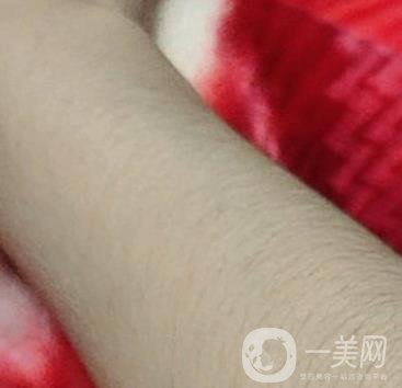 合肥華美整形醫(yī)院價(jià)格表，附脫毛案例