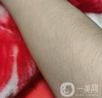 合肥華美整形醫(yī)院價(jià)格表，附脫毛案例