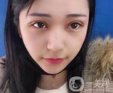 恩施州中心醫(yī)院美容整形科怎么樣？?jī)r(jià)格表和雙眼皮整形經(jīng)歷分享