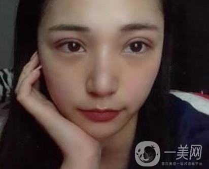 恩施州中心醫(yī)院美容整形科怎么樣？?jī)r(jià)格表和雙眼皮整形經(jīng)歷分享