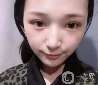 恩施州中心醫(yī)院美容整形科怎么樣？?jī)r(jià)格表和雙眼皮整形經(jīng)歷分享