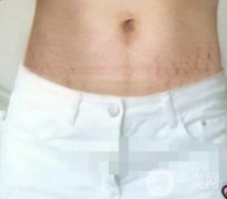 山西省汾陽(yáng)醫(yī)院美容整形科祛妊娠紋怎么樣？手術(shù)項(xiàng)目收費(fèi)價(jià)格表和案例一覽