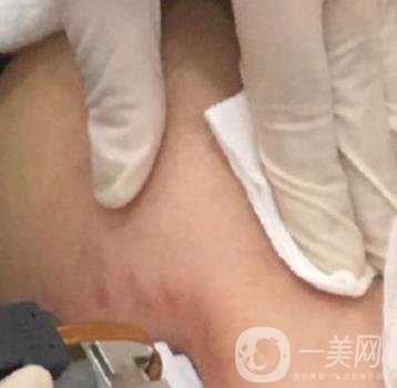 汾陽醫(yī)院美容整形科祛妊娠紋怎么樣？手術(shù)項目收費(fèi)價格表和案例一覽