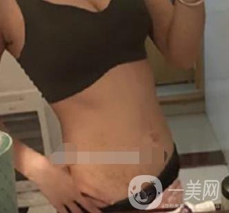 汾陽醫(yī)院美容整形科祛妊娠紋怎么樣？手術(shù)項目收費(fèi)價格表和案例一覽