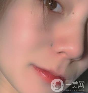 黃岡市中心醫(yī)院美容整形科祛痣多少錢？?jī)r(jià)格費(fèi)用表和*果圖精選